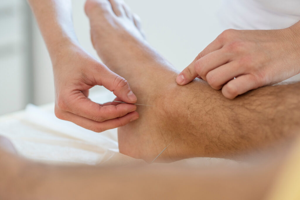man's foot being treated with dry needling to help plantar fasciitis